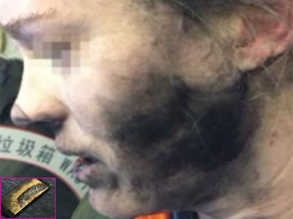 Headphone Batteries Explode On Flight: Woman suffers burns Headphone Batteries Explode On Flight: Woman suffers burns