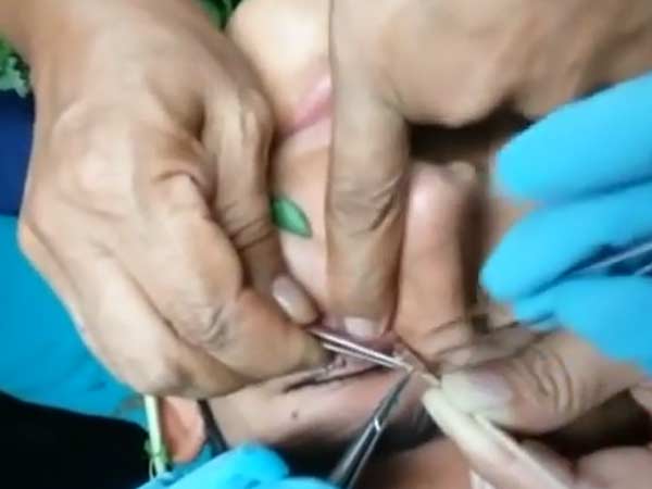 கருப்பையை மற்றும் அகற்றவில்லை