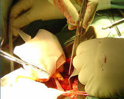 kidney transplant operation kidney transplant operation