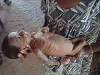 Malnourished child Malnourished child