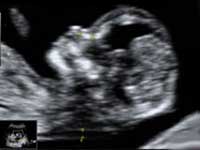Downs Syndrome scan a must during pregnancy Downs Syndrome scan a must during pregnancy