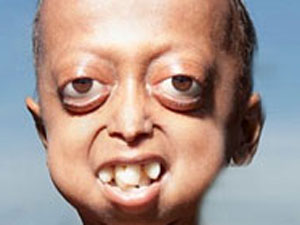 The curious case of Ali Hussain - a 14 year old with 110 year old body The curious case of Ali Hussain - a 14 year old with 110 year old body