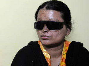 Acid attack survivor gets job in Supreme Court, thanks to Judge Acid attack survivor gets job in Supreme Court, thanks to Judge