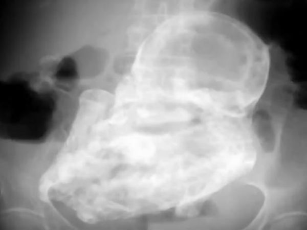 40-year-old foetus found in 82-year-old woman: report 40-year-old foetus found in 82-year-old woman: report