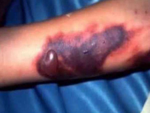 Experimental drug healed monkeys infected with Ebola Experimental drug healed monkeys infected with Ebola