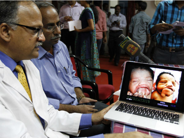 50 gram mouth tumour removed 50 gram mouth tumour removed