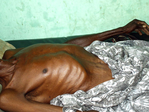 Free treatment in Nilgiri AIDS patients… Free treatment in Nilgiri AIDS patients…