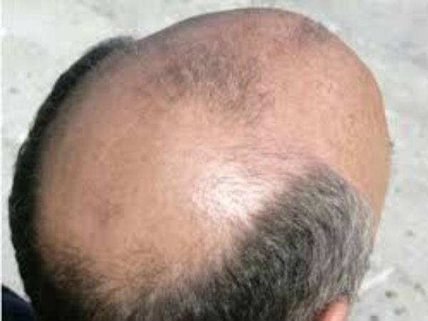 Hair Loss in Astrology remedies Hair Loss in Astrology remedies