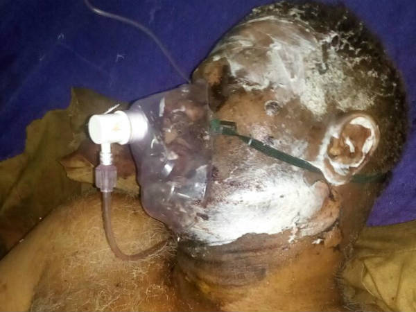 Kodungaiyur Bakkary fire accident, 3 in critical Kodungaiyur Bakkary fire accident, 3 in critical