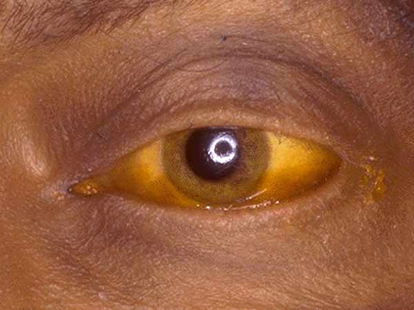 மஞ்சள் காமாலை