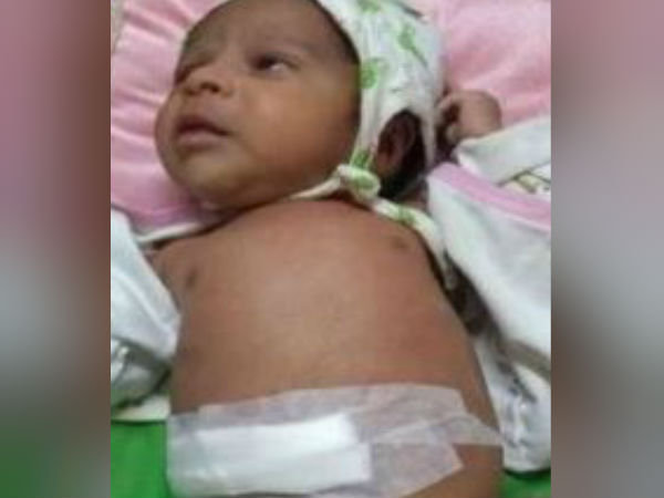 20 days old undergoes surgery for fetus removal 20 days old undergoes surgery for fetus removal