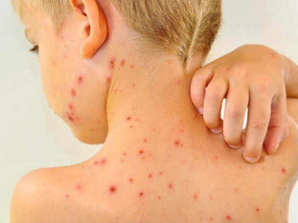 Pox cases on the rise in Nellai District Pox cases on the rise in Nellai District