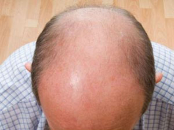 Madurai youth committed suicide over hair loss Madurai youth committed suicide over hair loss
