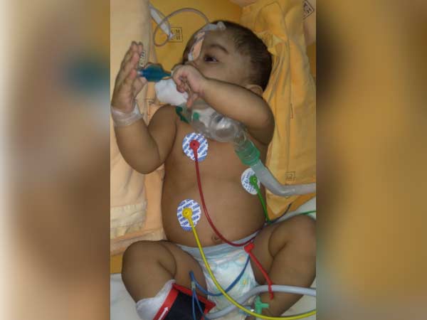 Even after 3 surgeries, this 1-year-old struggles for each breath Even after 3 surgeries, this 1-year-old struggles for each breath