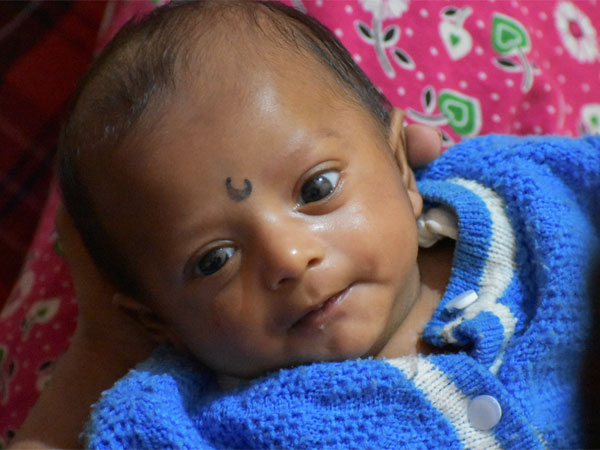 8-Month-Old Anirudh Seeks Your Help For His Final Surgery 8-Month-Old Anirudh Seeks Your Help For His Final Surgery
