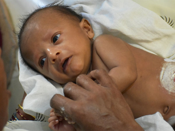 8-Month-Old Anirudh Seeks Your Help For His Final Surgery 8-Month-Old Anirudh Seeks Your Help For His Final Surgery