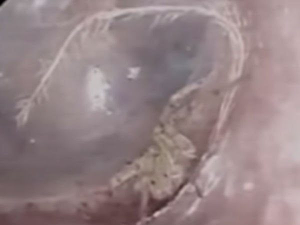 Doctors found spider nest in a mans ear Doctors found spider nest in a mans ear