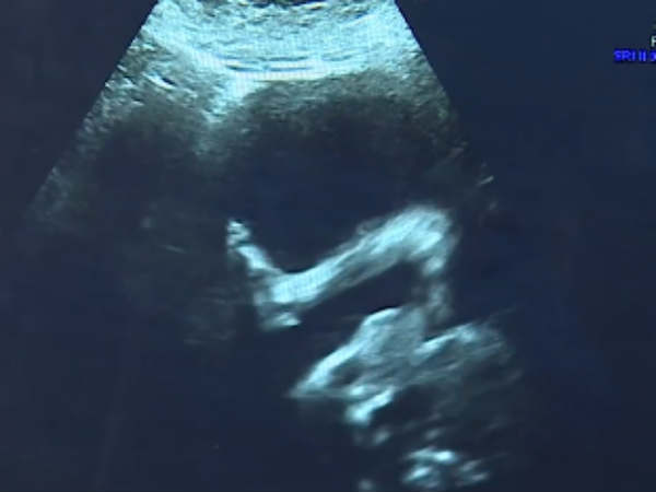 keyhole surgery used to repair babys spine in womb keyhole surgery used to repair babys spine in womb