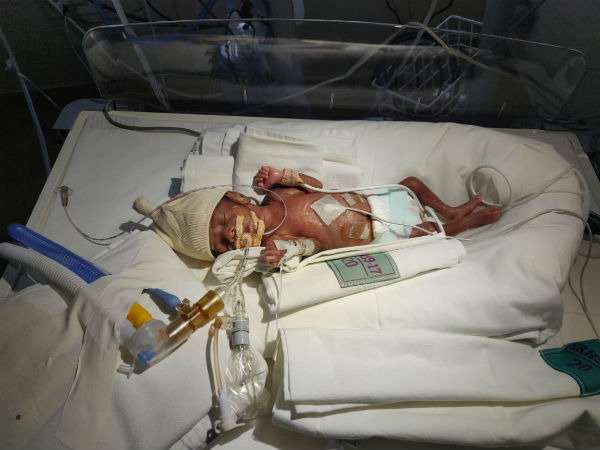 Help for new born premature twin babies for Treatment Help for new born premature twin babies for Treatment