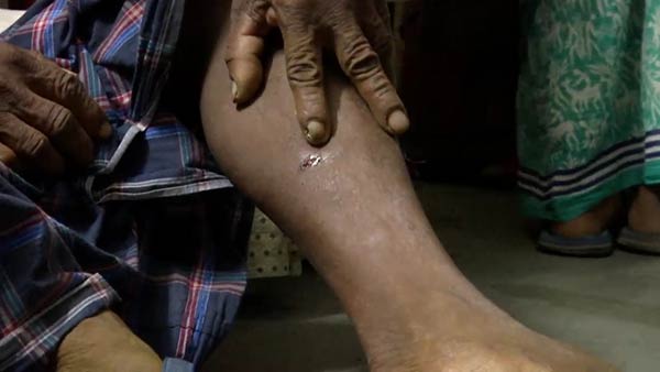Over 30 people bitten by rabid dog..People panic in Puducherry Over 30 people bitten by rabid dog..People panic in Puducherry