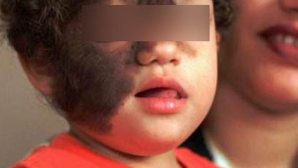 spain on Werewolf syndrome: 17 babies with out-of-control hair growth in drug mixup spain on Werewolf syndrome: 17 babies with out-of-control hair growth in drug mixup