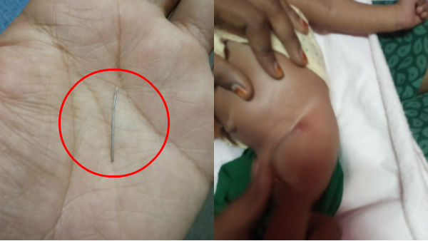 Mettupalayam Government Hospital negligence, baby affected with needle Mettupalayam Government Hospital negligence, baby affected with needle