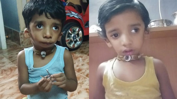 Help 2.5 year old Danish From Treacher Collins Syndrome Help 2.5 year old Danish From Treacher Collins Syndrome