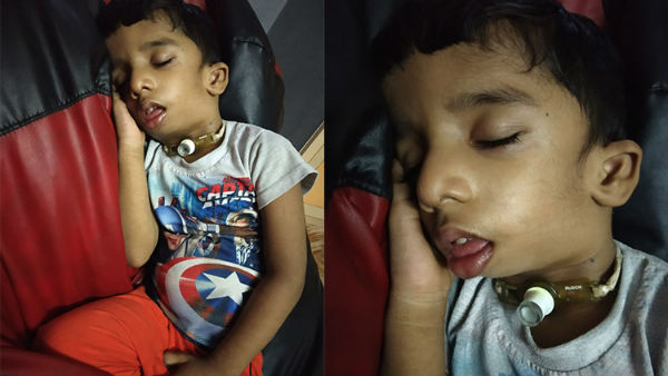 Help 2.5 year old Danish From Treacher Collins Syndrome Help 2.5 year old Danish From Treacher Collins Syndrome