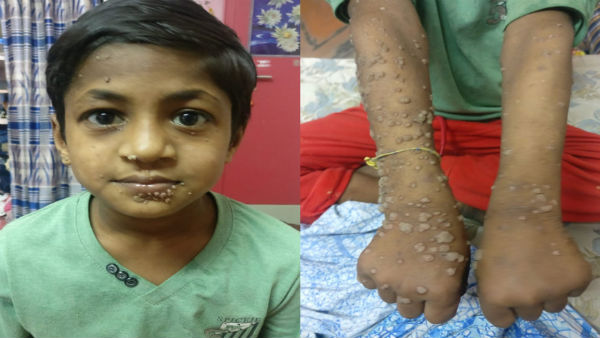 Help 11 year old Kavin From Hyper Ige Syndrom Help 11 year old Kavin From Hyper Ige Syndrom