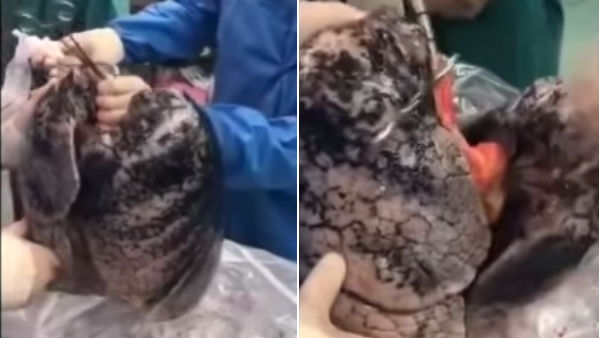 look at this lungs which has turned tar black colour by 30 years of smoking look at this lungs which has turned tar black colour by 30 years of smoking