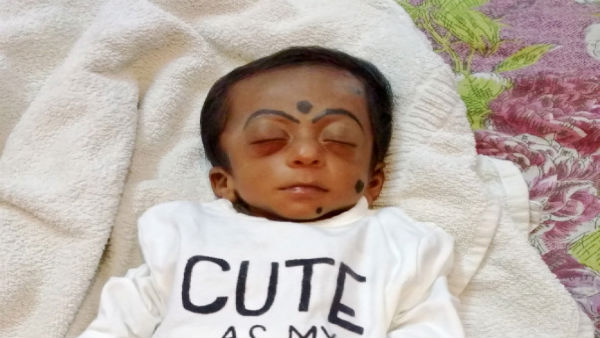 Help to save my 6 month old Baby From Glaucoma Help to save my 6 month old Baby From Glaucoma