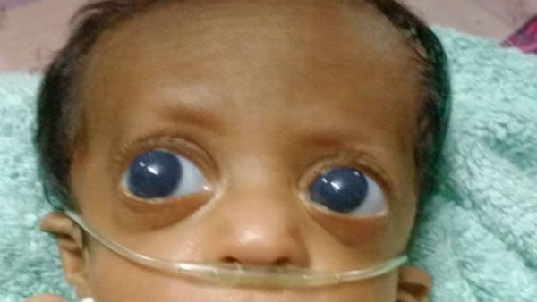 Help to save my 6 month old Baby From Glaucoma Help to save my 6 month old Baby From Glaucoma