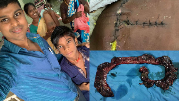 Tanjore government hospital perform a risky operation on a boy stomach Tanjore government hospital perform a risky operation on a boy stomach