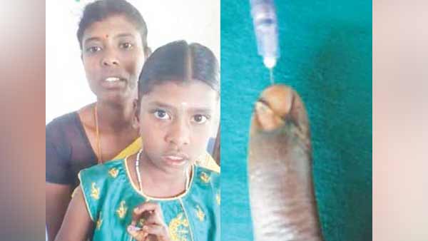 Government hospital doctor fixes girls severed finger Government hospital doctor fixes girls severed finger