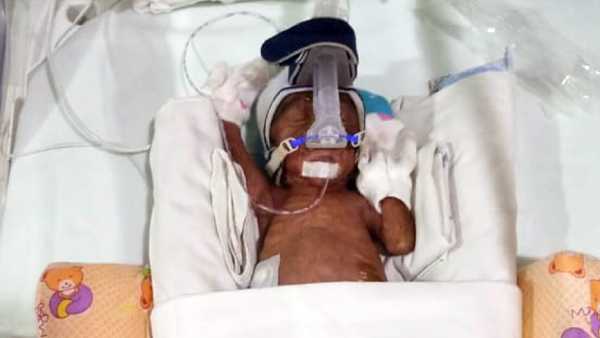 4 weeks old premature baby need your support to survive 4 weeks old premature baby need your support to survive