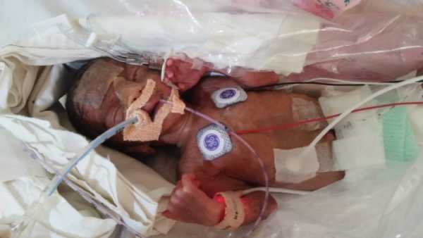 4 weeks old premature baby need your support to survive 4 weeks old premature baby need your support to survive