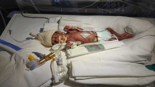 4 weeks old premature baby need your support to survive 4 weeks old premature baby need your support to survive