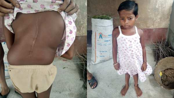 Help 9-year-old Disha recover from congenital scoliosis with tethered cord syndrome Help 9-year-old Disha recover from congenital scoliosis with tethered cord syndrome