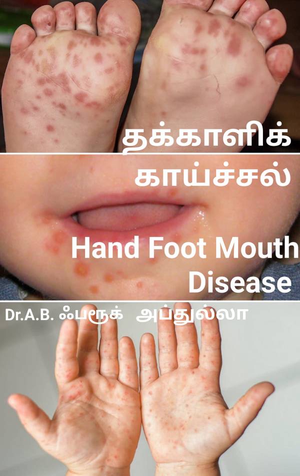 தக்காளி காய்ச்சல் வந்தால் என்ன செய்ய வேண்டும்? எதை செய்யக் கூடாது! அரசு