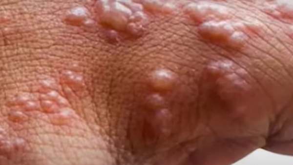 இந்தியாவில் கண்காணிப்பு தீவிரம்