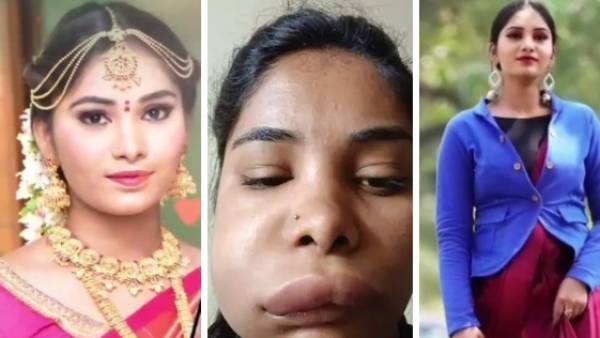 பல் வலிக்கு சிகிச்சை.. பிரபல நடிகையின் முகம் வீங்கியது.. 20 நாட்களாக அவதி! 