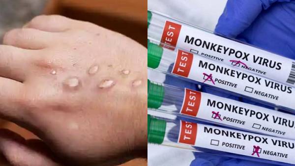 குழந்தைகளுக்கு பரவும் குரங்கு அம்மை? உலகம் முழுவதும் அதிகரிக்கும் பாதிப்பு! நிபுணர்கள் சொல்வதென்ன? 