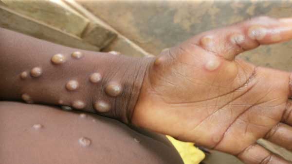 மங்கி பாக்ஸ்