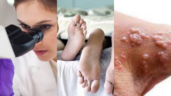 குரங்கு அம்மையை கட்டுப்படுத்த பாலியல் “பார்ட்னர்களை” குறைப்பதே ஒரே வழி.. WHO முக்கிய அறிவுரை 