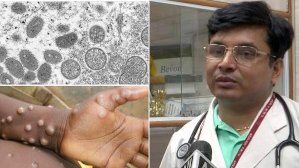  குழந்தைகளுக்கு மங்கி பாக்ஸ் ஏற்பட்டால் உயிருக்கே ஆபத்து! கொரோனாவை விட மோசமாம்! எச்சரிக்கும் எய்ம்ஸ்