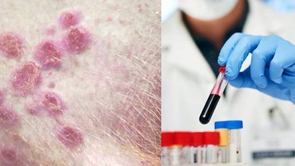 குரங்கு அம்மை குழந்தைகள் உயிருக்கே ஆபத்தாக மாறக்கூடும்.. கண்பார்வை பாதிக்கலாம்: மருத்துவ நிபுணர்