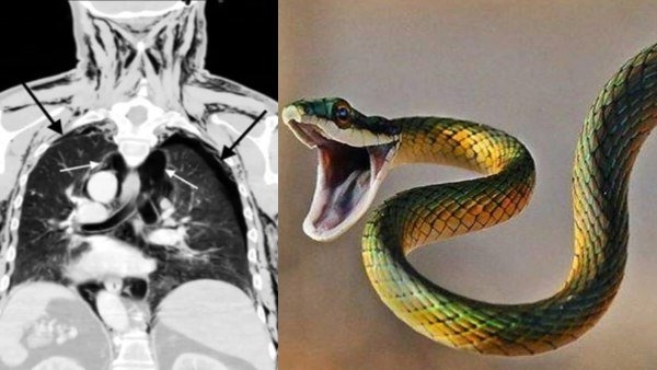 “அந்த” இடத்தில் ஹுஸ் ஹுஸ் சத்தம்! டாக்டர்! டாய்லெட் போறப்ப பாம்பு “உள்ளே” போயிடுச்சி! அலறிய முதியவர் 