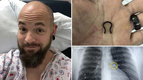 5 ஆண்டுகளுக்கு முன் தொலைத்த 'நோஸ் ரிங்'..கண்டுபிடிக்கப்பட்ட இடம் தான் அல்டிமேட்..மருத்துவர்கள் ஷாக்! 