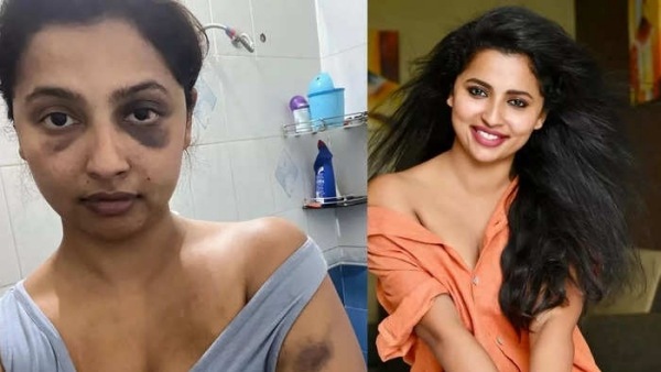 முன்னாள் காதலனால்.. கண், மார்பு எல்லா இடத்திலும் காயம்.. பிரபல தமிழ் நடிகைக்கு நடந்த அதிபயங்கரம் 