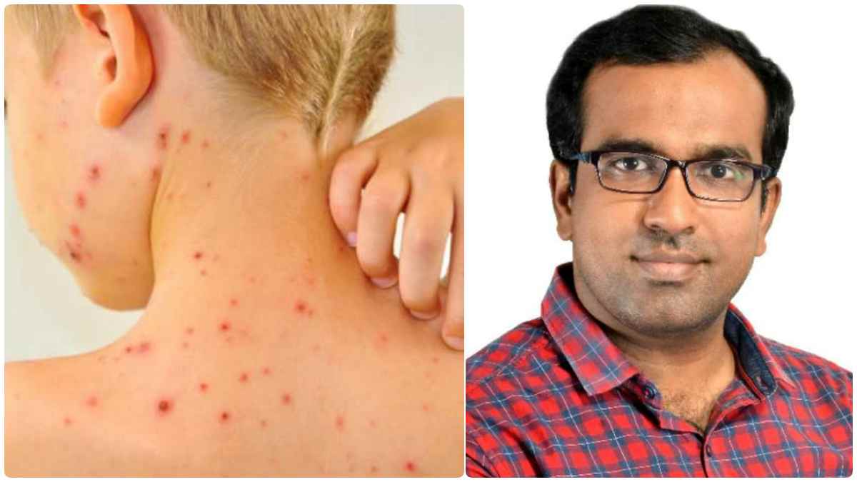 பெயர்தான் சின்னம்மை.. தும்மினாலும் சின்னம்மை.. ஆபத்தான விளைவுகளை